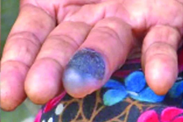 অ্যানথ্রাক্স : ছবি সংগ্রহ