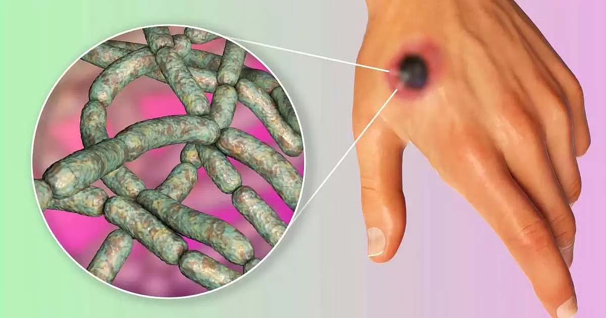 অ্যানথ্রাক্স জীবাণু : ছবি সংগ্রহ 